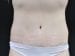 Tummy Tuck Patient 18 - After Thumbnail 