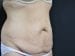 Tummy Tuck Patient 18 - Before Thumbnail 