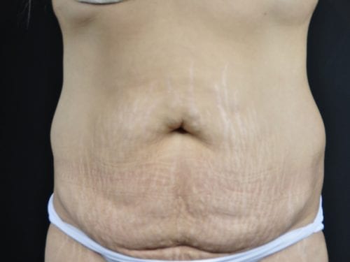 Tummy Tuck Patient 18 - Before Thumbnail