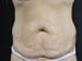 Tummy Tuck Patient 18 - Before Thumbnail 