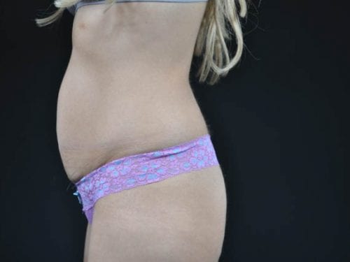 Tummy Tuck Patient 19 - Before Thumbnail