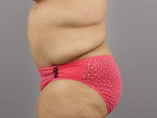 Tummy Tuck Patient 20 - After 