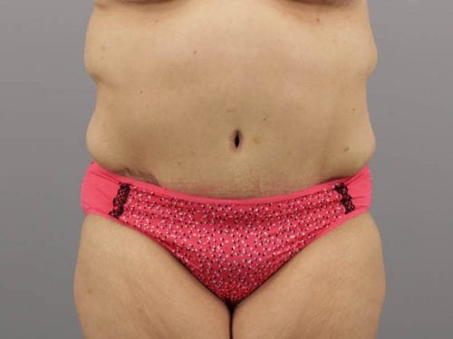 Tummy Tuck Patient 20 - After 