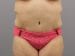 Tummy Tuck Patient 20 - After Thumbnail 