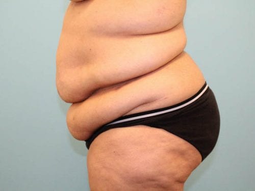 Tummy Tuck Patient 20 - Before 