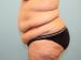 Tummy Tuck Patient 20 - Before Thumbnail 