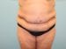 Tummy Tuck Patient 20 - Before Thumbnail 