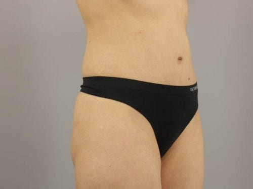 Tummy Tuck Patient 21 - After 