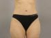 Tummy Tuck Patient 21 - After Thumbnail 