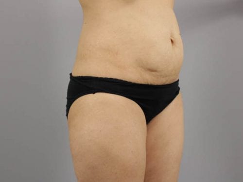 Tummy Tuck Patient 21 - Before 
