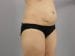 Tummy Tuck Patient 21 - Before Thumbnail 