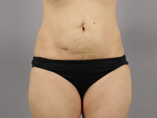 Tummy Tuck Patient 21 - Before 