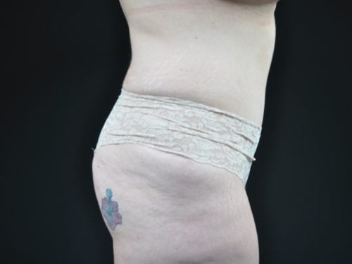 Tummy Tuck Patient 22 - After 