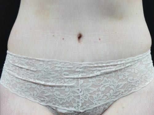 Tummy Tuck Patient 22 - After 