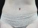 Tummy Tuck Patient 22 - After Thumbnail 