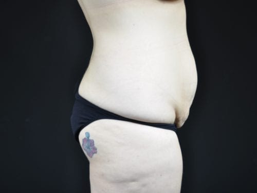Tummy Tuck Patient 22 - Before 