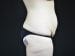Tummy Tuck Patient 22 - Before Thumbnail 