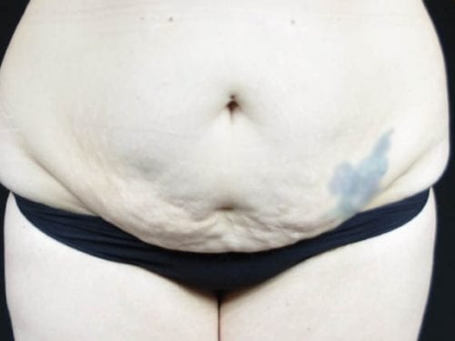 Tummy Tuck Patient 22 - Before 