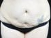 Tummy Tuck Patient 22 - Before Thumbnail 