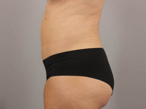 Tummy Tuck Patient 23 - After Thumbnail