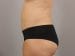 Tummy Tuck Patient 23 - After Thumbnail 