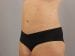 Tummy Tuck Patient 23 - After Thumbnail 