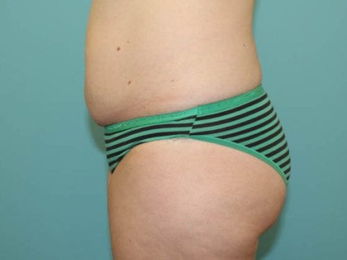 Tummy Tuck Patient 23 - Before Thumbnail