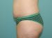 Tummy Tuck Patient 23 - Before Thumbnail 