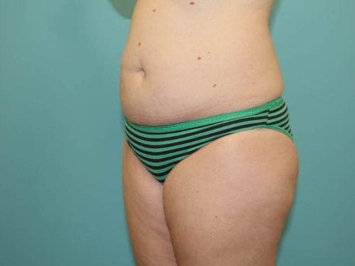 Tummy Tuck Patient 23 - Before 