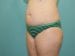 Tummy Tuck Patient 23 - Before Thumbnail 