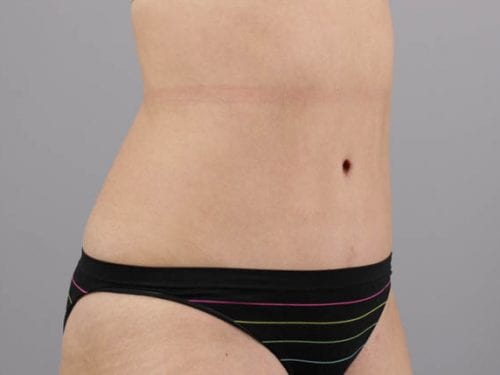 Tummy Tuck Patient 24 - After Thumbnail
