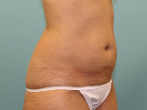 Tummy Tuck Patient 24 - Before Thumbnail