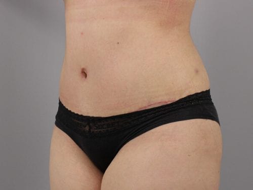 Tummy Tuck Patient 25 - After 