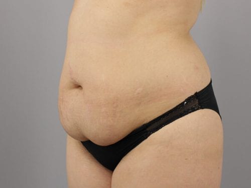 Tummy Tuck Patient 25 - Before 