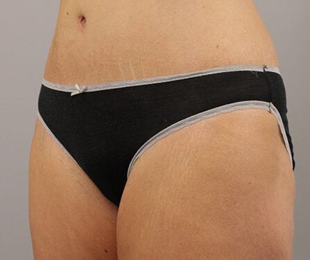Tummy Tuck Patient 26 - After 2