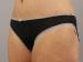 Tummy Tuck Patient 26 - After Thumbnail 