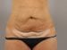 Tummy Tuck Patient 26 - Before Thumbnail 