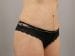 Tummy Tuck Patient 27 - After Thumbnail 