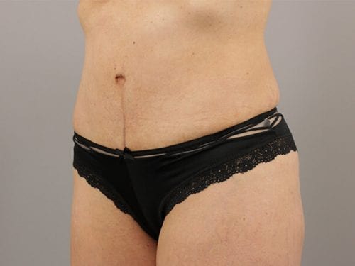 Tummy Tuck Patient 27 - After 