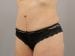 Tummy Tuck Patient 27 - After Thumbnail 