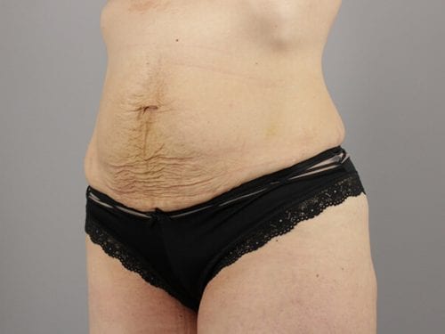 Tummy Tuck Patient 27 - Before 