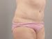 Tummy Tuck Patient 12 - After Thumbnail 