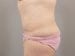 Tummy Tuck Patient 12 - After Thumbnail 