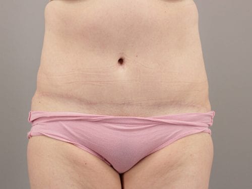 Tummy Tuck Patient 12 - After 