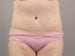 Tummy Tuck Patient 12 - After Thumbnail 