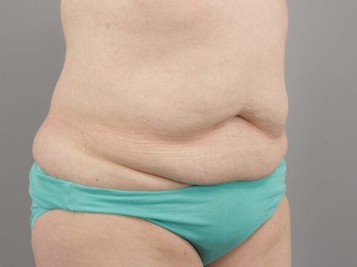 Tummy Tuck Patient 12 - Before 