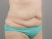 Tummy Tuck Patient 12 - Before Thumbnail 