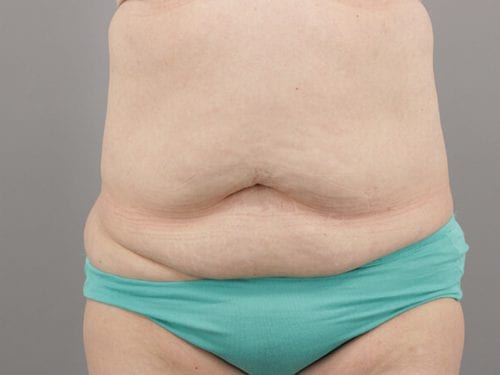 Tummy Tuck Patient 12 - Before 