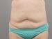 Tummy Tuck Patient 12 - Before Thumbnail 
