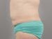Tummy Tuck Patient 12 - Before Thumbnail 